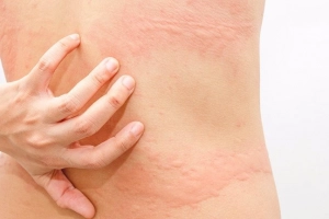 Nổi mề đay kéo dài không đỡ điều trị thế nào?