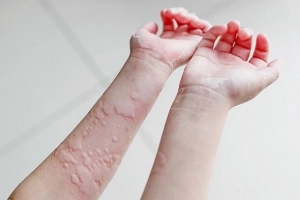 Nổi mề đay kiêng gì để giảm ngứa?