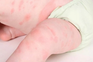 Nổi mề đay ở trẻ sơ sinh