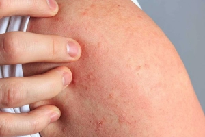 Nổi mề đay sau sinh có thuốc trị dứt điểm không?