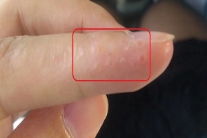 Nổi mụn nước kèm ngứa ngón tay vào mùa hè là bệnh gì?