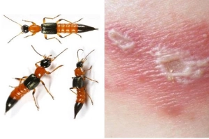 Nổi mụn nước phồng rộp sau bị kiến ba khoang cắn phải làm sao?