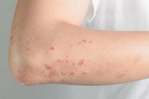 Nổi nốt đỏ kèm ngứa là dấu hiệu bệnh gì?