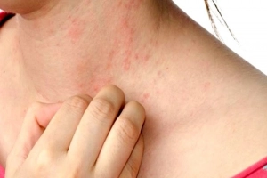 Nổi nốt đỏ ngứa có bọng nước là bệnh gì?