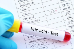 Nồng độ axit uric cao có ảnh hưởng gì?