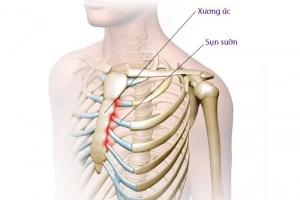 Nữ giới đau xương ức điều trị như thế nào?