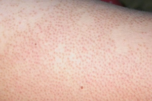 Nữ giới viêm lỗ chân lông điều trị như thế nào?