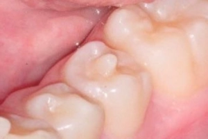 Núm phụ: Bất thường răng cần chú ý