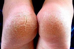 Nứt gót chân gây ngứa kèm chảy máu là bệnh gì?