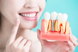 Phải làm sao để lấp khoảng trống do mất 2 răng số 6 hàm dưới?