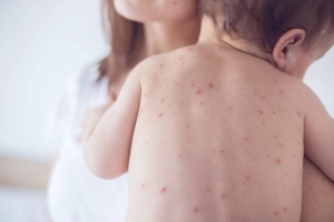 Phân biệt hình ảnh bệnh sốt xuất huyết ở trẻ em