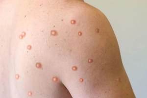 Phân biệt triệu chứng bệnh đậu mùa khỉ và thủy đậu