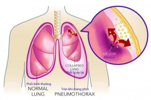Phân biệt u màng phổi và tràn dịch màng phổi bằng kỹ thuật nào?