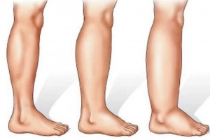 Phân loại chẩn đoán và điều trị mày đay phù mạch