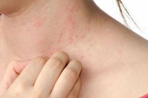 Phát ban ngứa khắp người khi mắc sốt xuất huyết có sao không?