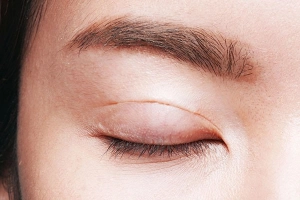 Phẫu thuật cắt u mi mắt, mí mắt