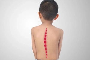 Phẫu thuật chỉnh vẹo cột sống ở trẻ