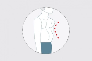 Phẫu thuật điều trị lõm ngực bẩm sinh