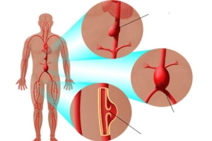 Phẫu thuật điều trị phình động mạch chủ bụng dưới thận