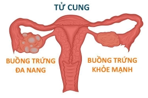 Phẫu thuật nội soi đốt điểm buồng trứng điều trị buồng trứng đa nang