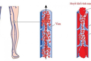 Phòng ngừa huyết khối tĩnh mạch trong và sau phẫu thuật