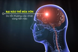 Phục hồi chức năng cho bệnh nhân bại não thể múa vờn thế nào?