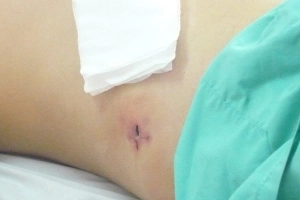 Phương pháp gây mê ít tác dụng phụ khi mổ ruột thừa cấp?
