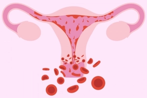 Polyp cổ tử cung và nguy cơ tiến triển ác tính