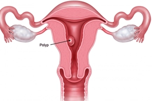 Polyp lòng tử cung có nguy hiểm không?