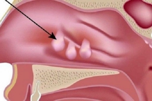 Polyp mũi độ 3 một bên có nguy hiểm không?