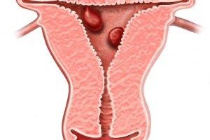 Polyp nội mạc tử cung: Các triệu chứng bạn nên biết