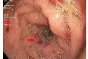 Quan điểm hiện tại về mối quan hệ giữa Helicobacter pylori và ban xuất huyết Henoch-Schonlein ở trẻ em