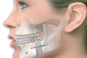 Quên bỏ đinh gãy xương mặt hàm trên 5 năm có tháo được không?