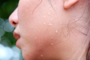 Ra nhiều mồ hôi ở mặt là bệnh gì?