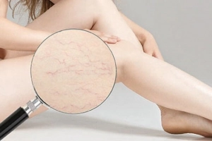 Rạn da: Nguyên nhân hình thành, cách điều trị