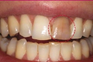 Răng chết tủy đổi màu có làm sáng được không?