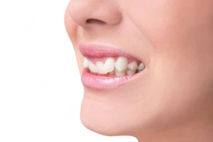 Răng khấp khểnh có nên niềng?