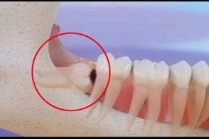 Răng khôn bị sâu có trám được không hay nên nhổ?