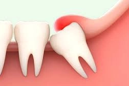 Răng khôn mọc lệch có ảnh hưởng đến khớp thái dương hàm không?