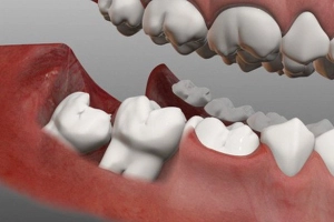 Răng khôn mọc lệch trông như thế nào?