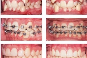 Răng &quot;chạy&quot; về vị trí cũ sau niềng, vì sao?