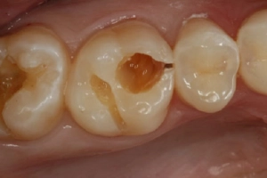 Răng số 6 hàm trên bị sâu có nên nhổ không?