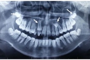 Răng thừa mọc ngầm có phải nhổ không?