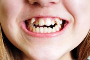 Răng thừa ở trẻ em có gây hại không?