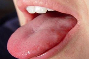 Rát lưỡi kèm nổi u ở bờ lưỡi có phải ung thư lưỡi không?