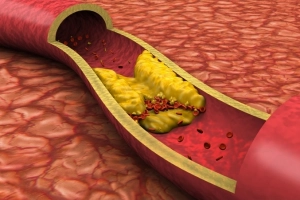 Rối loạn chuyển hóa lipid máu