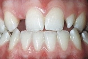 Rối loạn tạo răng có nguy hiểm?