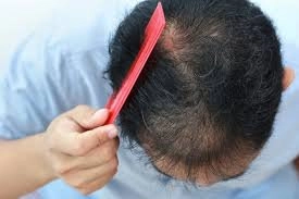 Rụng nhiều tóc do ngứa da đầu nên làm gì để cải thiện?