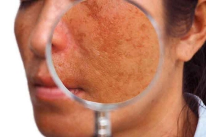 Sắc tố da là gì và nó có phải lý do gây ra các đốm đen trên khuôn mặt?