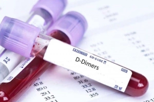 Sản phụ xét nghiệm D-dimer có chỉ số 7387 sau khỏi Covid có sao không?